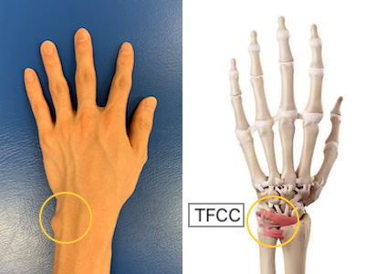 TFCC損傷の治療法 | 佐久平整形外科クリニック