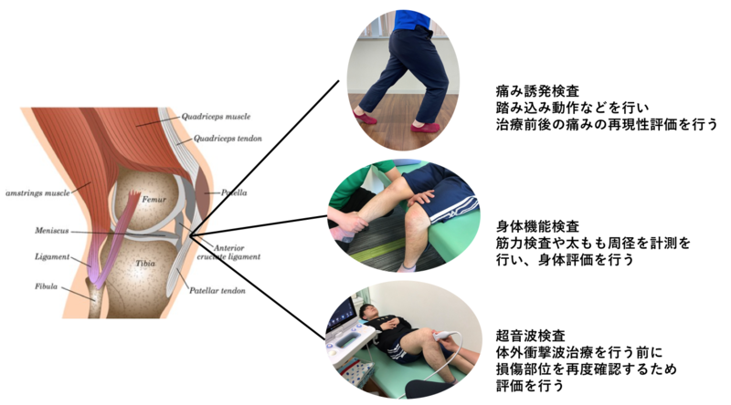 治りづらい膝蓋腱炎の治療方法 Ar Ex スポーツ 難治性疼痛外来