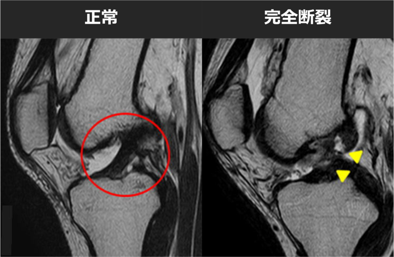 前十字靭帯とは | 都立大整形外科クリニック