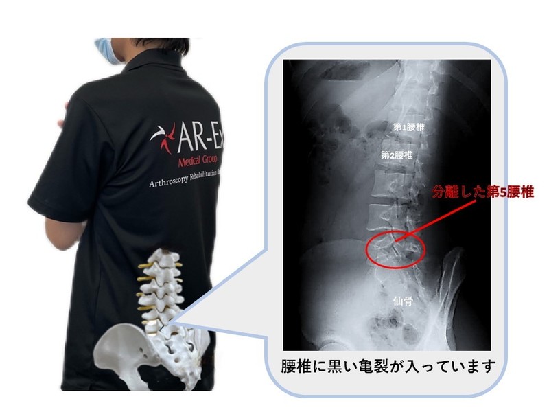 腰椎分離症の症状とその原因、運動療法について | アレックス脊椎クリニック