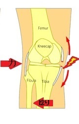 膝関節内側側副靭帯 Mcl 損傷 長野整形外科クリニック