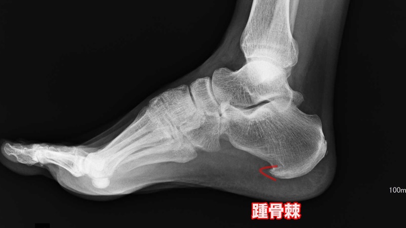 足底腱膜炎の治し方 都立大整形外科クリニック