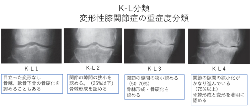 膝関節伸展制限 ～後方組織の問題を紐解く～｜Y.K