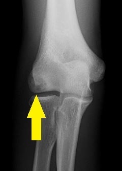 野球少年に多い肘の外側の痛み 肘離断性骨軟骨炎 長野整形外科クリニック