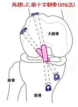 前十字靭帯再建術 | 上田整形外科内科