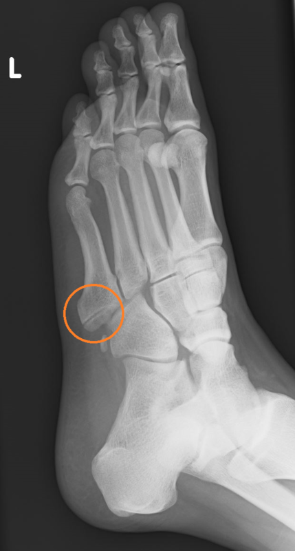 足 の 小指 骨折 レントゲン