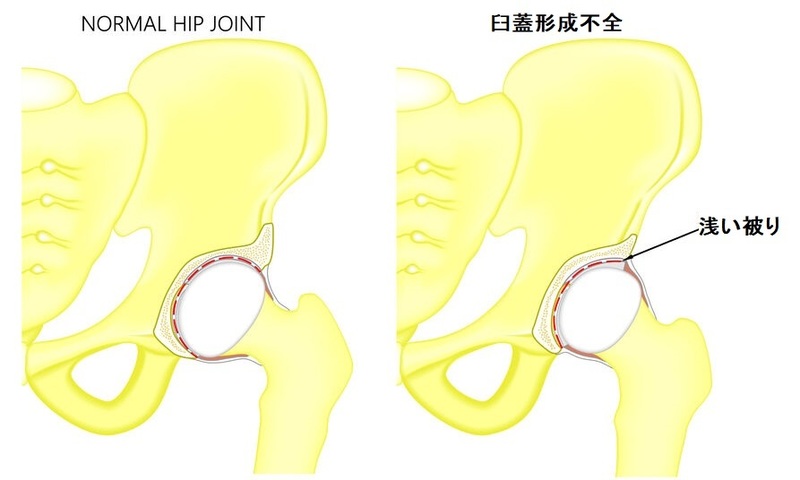 中高年の女性に多い股関節の痛みの原因 臼蓋形成不全 長野整形外科クリニック