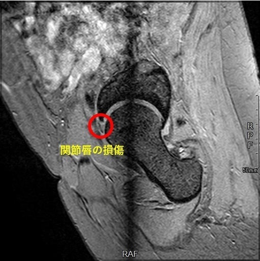 足の付け根の痛み、股関節の前側の痛み「股関節唇損傷」 | 長野整形外科クリニック