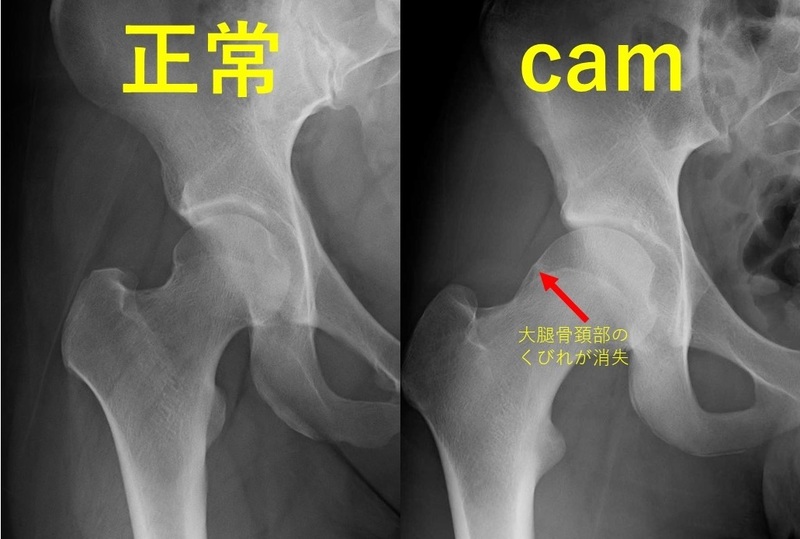 足の付け根の痛み、股関節の前側の痛み「股関節唇損傷」 | 長野整形外科クリニック