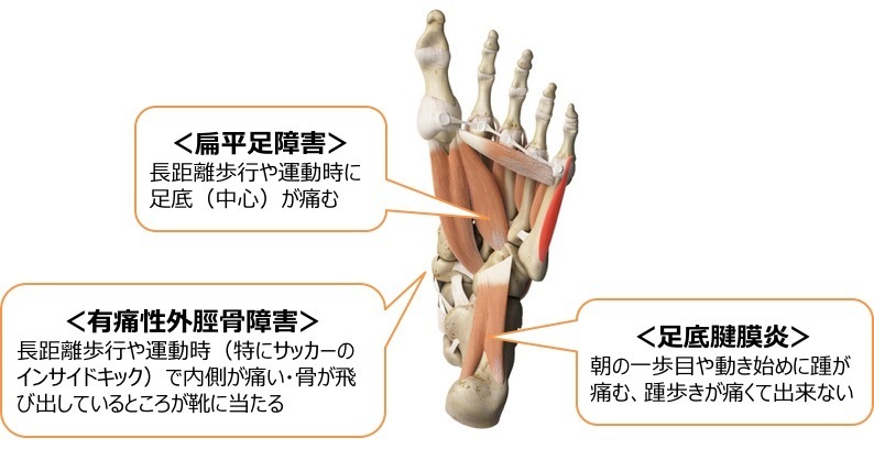 の 痛い が 足 内側 足の付け根が痛い！９つの原因と効果的なストレッチ６選｜ヘルモア