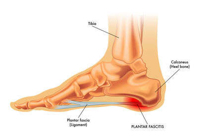 治りづらい足底腱膜炎の治療方法
