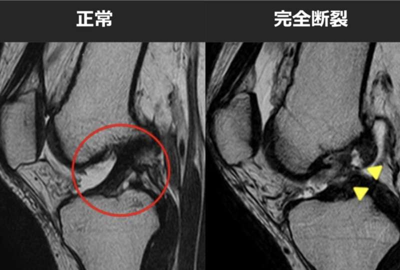 前十字靭帯とは | 都立大整形外科クリニック