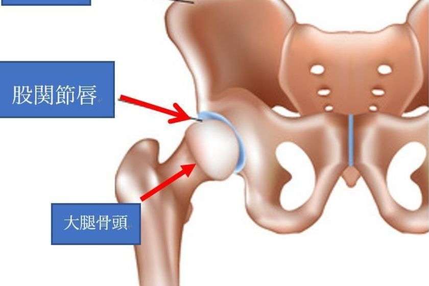 股関節の最新治療について | 長野整形外科クリニック